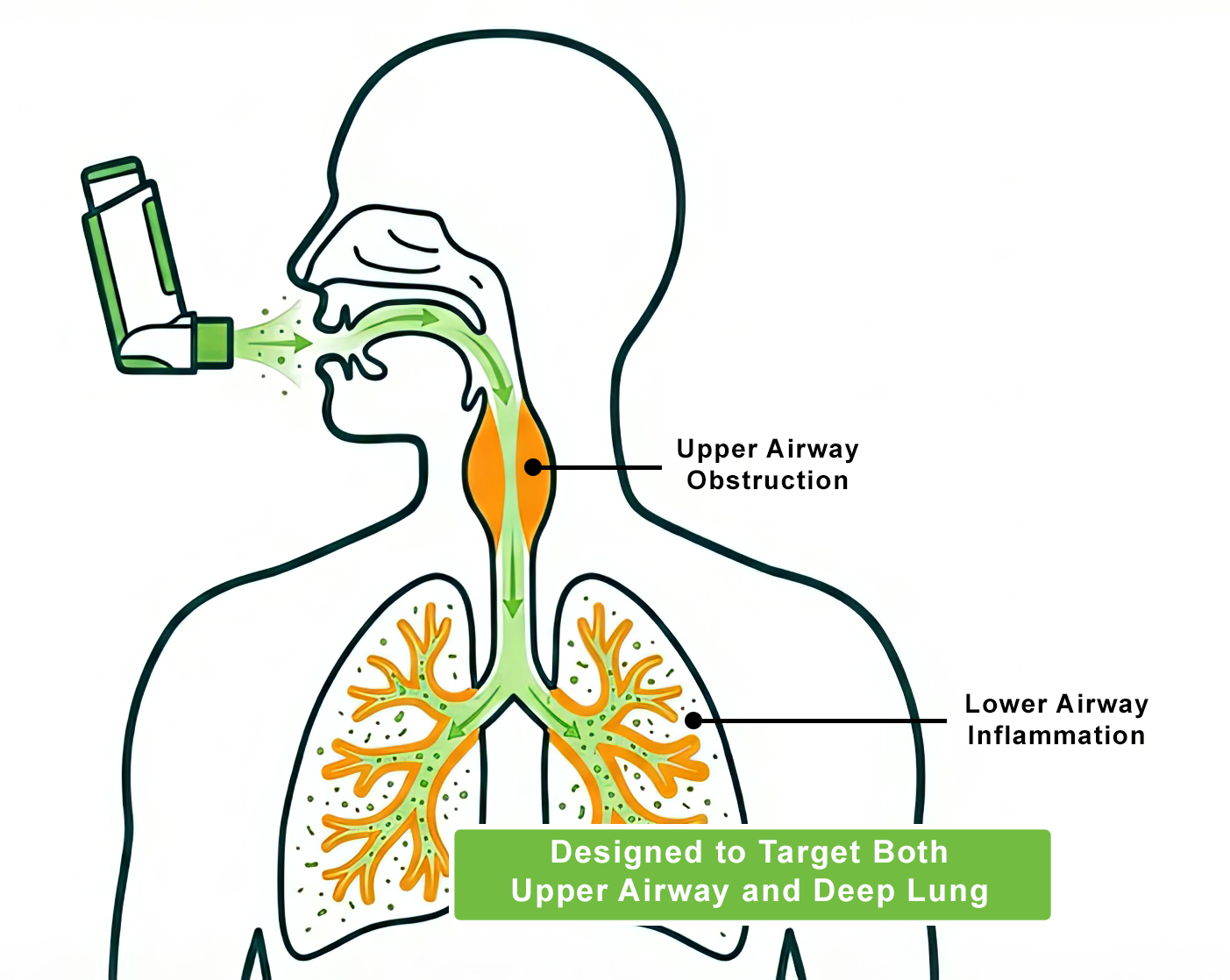 Diagram showing inhaled epinephrine targeting both upper airway obstruction and lower airway inflammation
